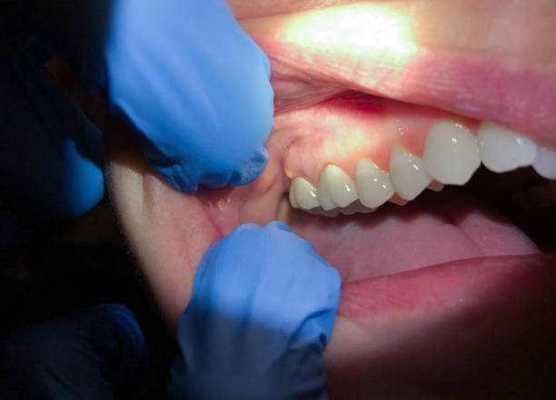 Best Emergency Care for Gum Disease in Versailles, PA